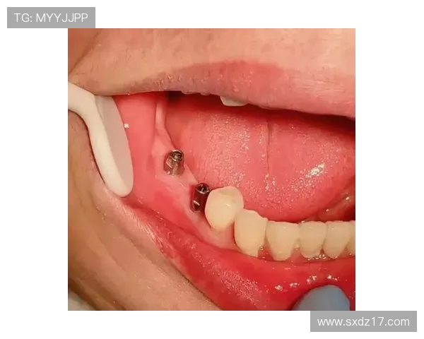 奇克遭遇牙槽骨骨折多颗牙齿脱落或将影响近期进食与讲话能力